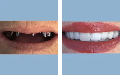 Before and After